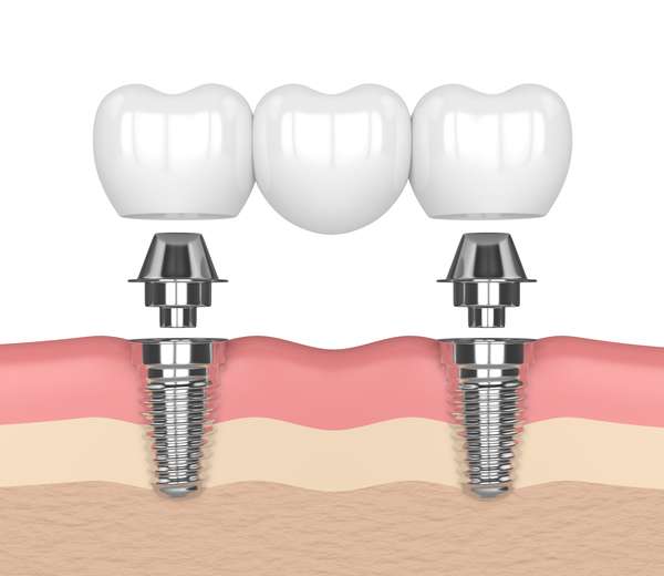 Dental Implants Linden, NJ